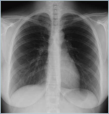 La radiographie - Radiologie Bordeaux