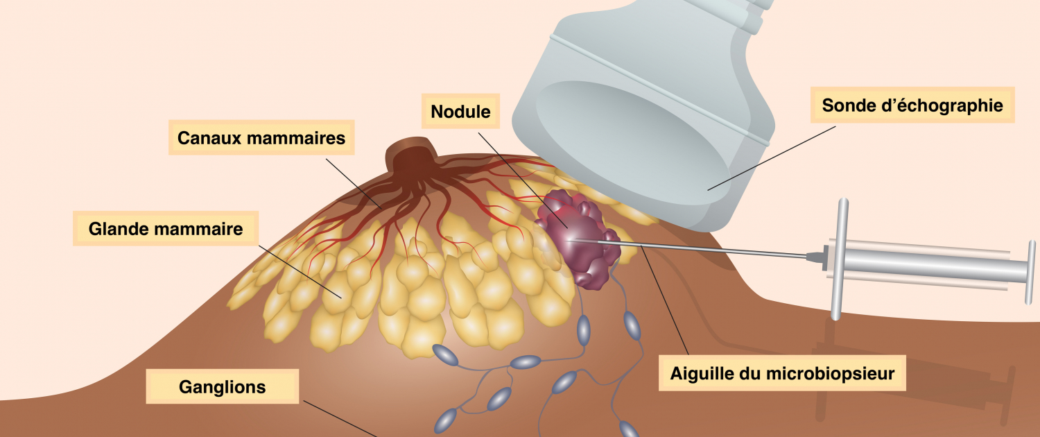 La micro-biopsie mammaire - Radiologie Bordeaux